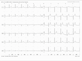 Кук суп со клиническая интерпретация экг