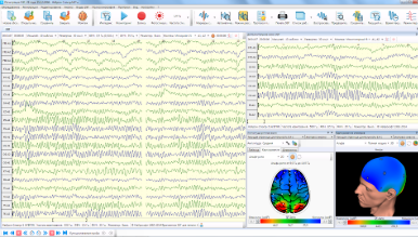 EEG acquisition