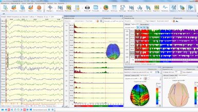 Graphs of EEG spectral and coherent analysis results