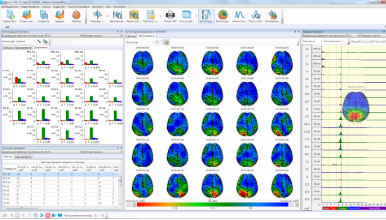 Brain mapping and bar charts of EEG analysis results