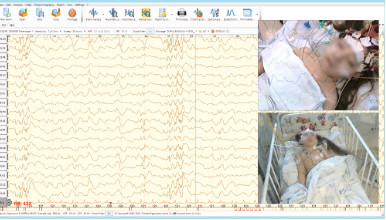 Review of EEG and video from two cameras