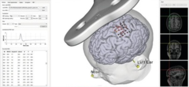 The principles and application of MRI-Guided Neuronavigation